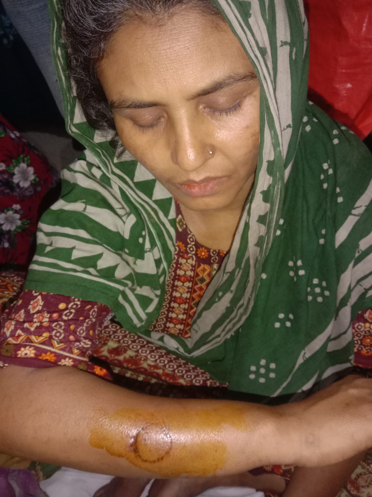 বরিশালে ছাগল ব্যবসায়ির কামড়ে গৃহবধূ হাসপাতালে..
